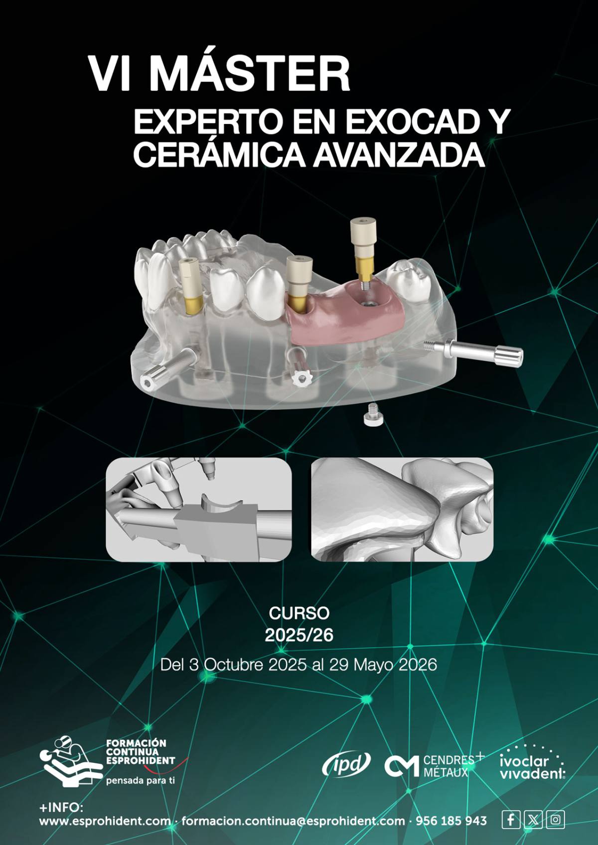 VI Máster en Exocad y Cerámica Avanzada