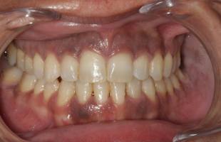 Encías negras o melanosis gingival