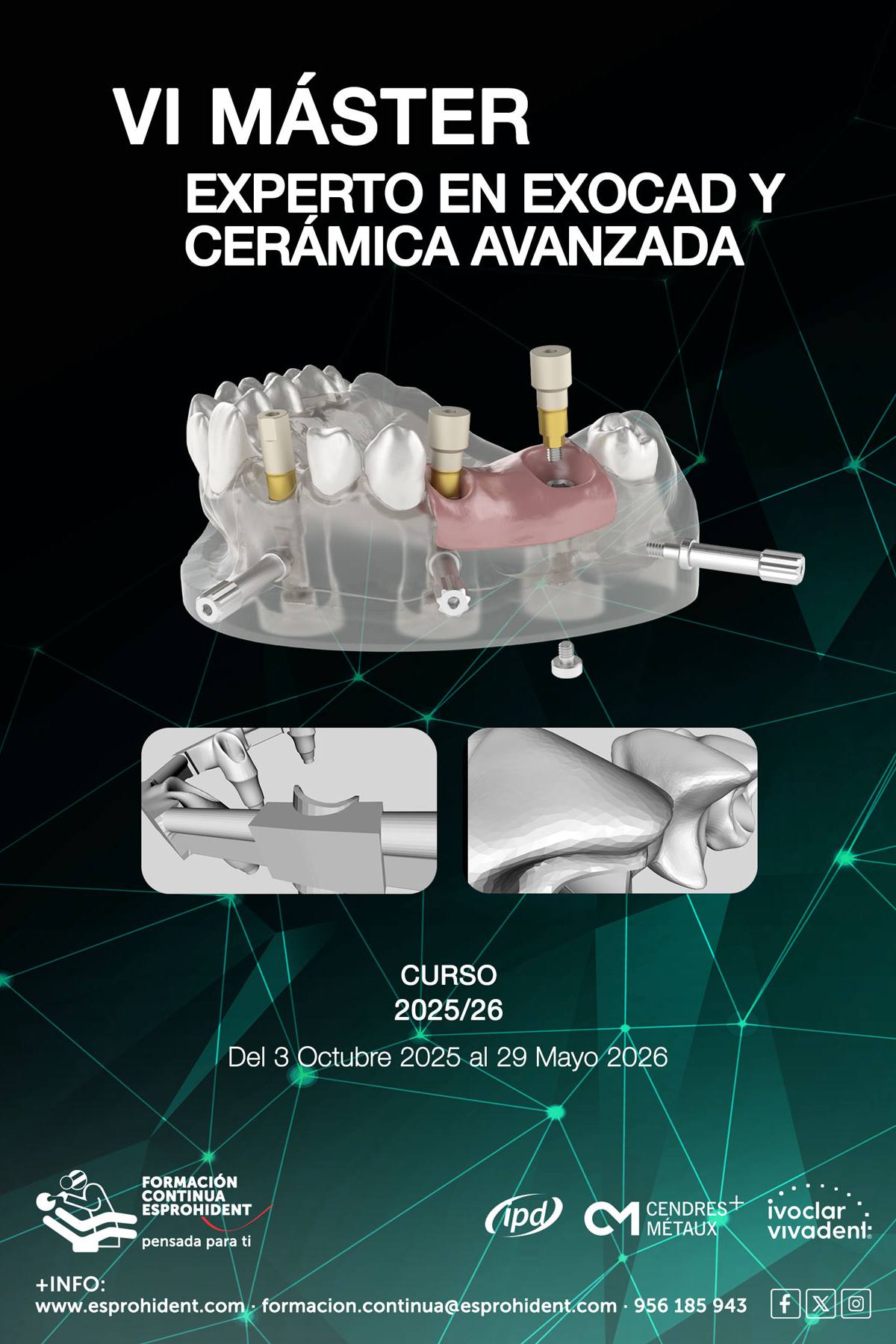 VI Máster en Exocad y Cerámica Avanzada