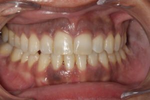 antes melanosis gingival